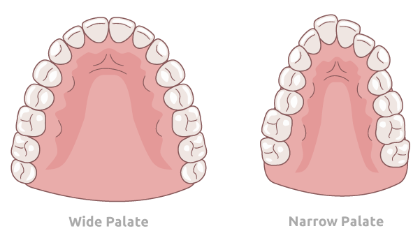 A graphic shows the differences between a wide palate and a narrow palate.